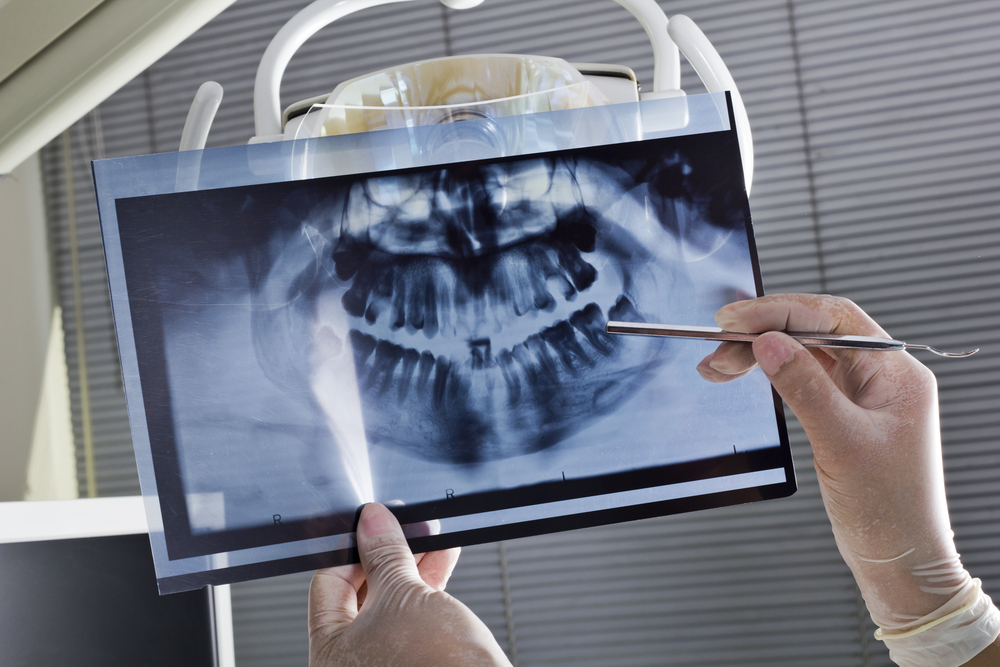 Dentist examining a child’s dental X-ray before performing a frenectomy procedure.