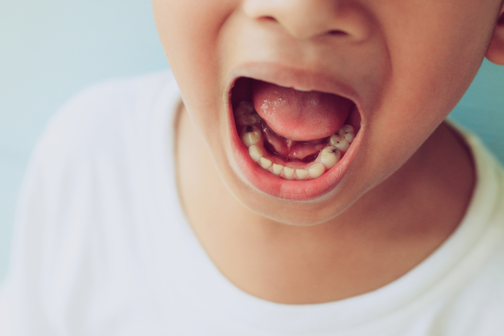 Child with visible early signs of cavities on lower teeth during an oral examination